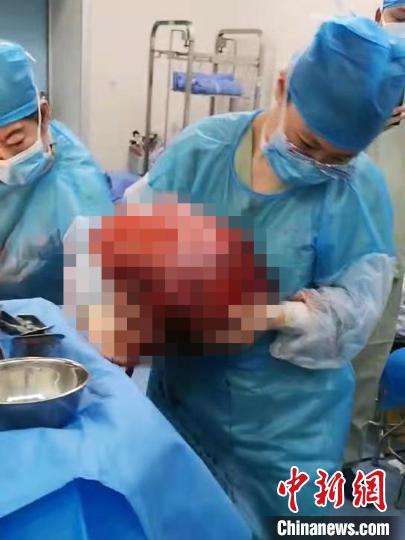 女子“孕”态十足 医生从腹中摘除24斤巨大肿瘤