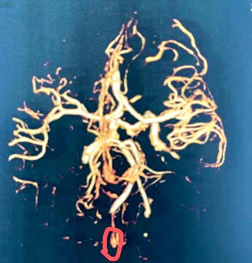 22岁女孩突发颅动脉瘤破裂专家：或与长期熬夜喝咖啡有关
