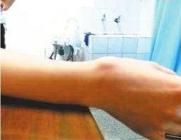 每天狂敲键盘女会计手腕鼓起“鸽蛋”